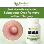 Home Remedies for Sebaceous Cyst.jpg Home Remedies for Sebaceous Cyst.jpg